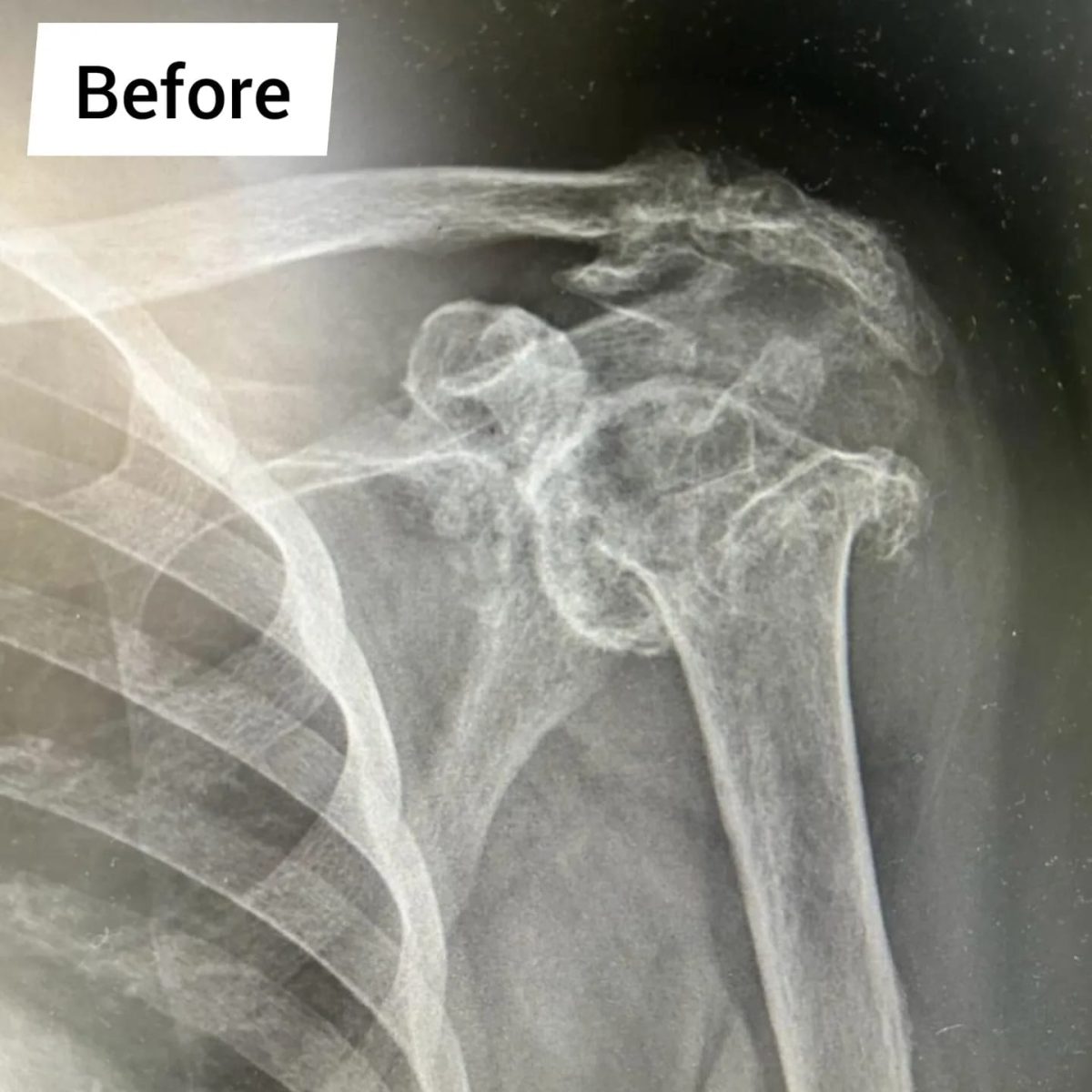 Reverse Total Shoulder Replacement2